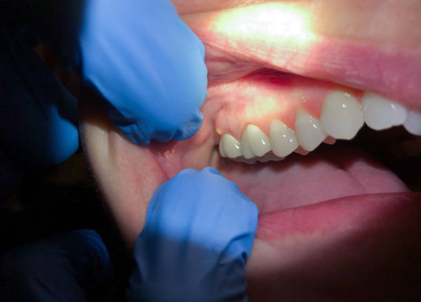 Best Broken or Chipped Tooth Repair in Maple Bluff, WI